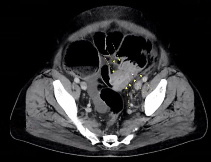 Stenosierendes Sigmakarzinom bei einem 48-jährigen Mann