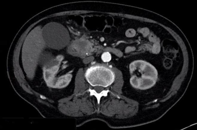 74-jähriger Mann mit einem Pankreaskopfkarzinom mit Infiltration des Duodenums
